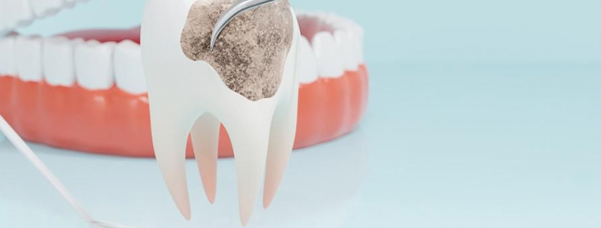 Dampak Buruk Infeksi Gigi yang Telah Menyebar